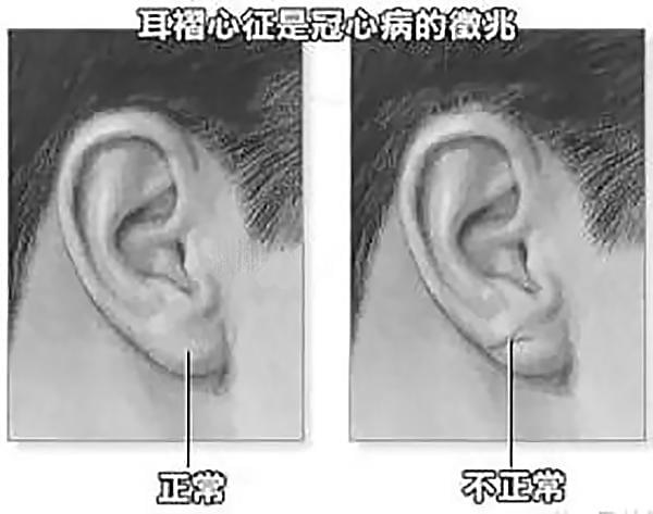 正常人的耳垂应该是饱满平滑无褶皱的,如果发现耳垂上出现了一条折痕