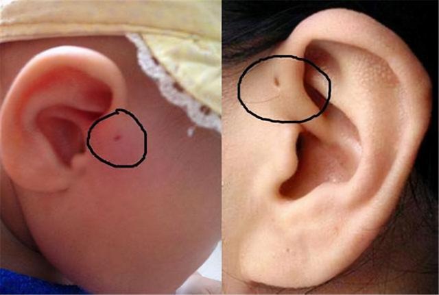 宝宝耳朵上的小孔是有福气的象征吗父母尽量别大意
