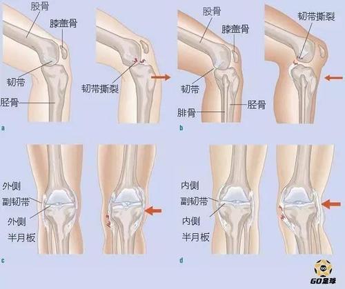 膝盖扭伤: 支撑膝盖骨部位的韧带拉伤或撕裂 膝关节前部,侧面或背部的
