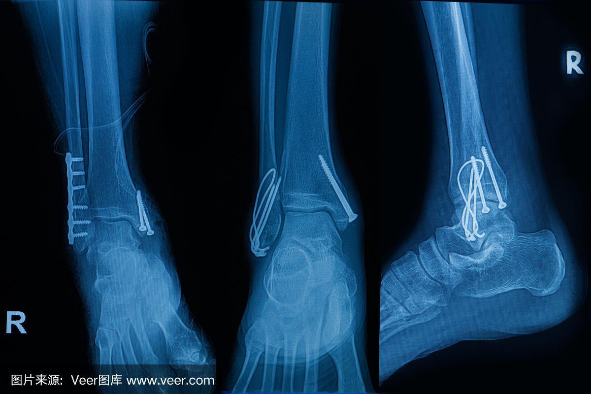 人类x光片显示右腿骨折