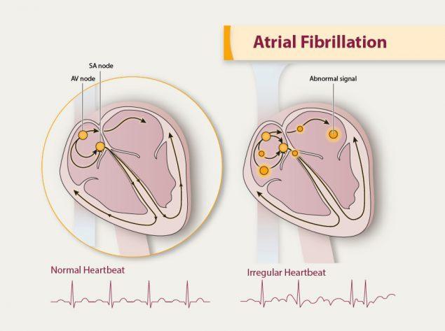 atrial-fibrillation-medium ecg22.jpg