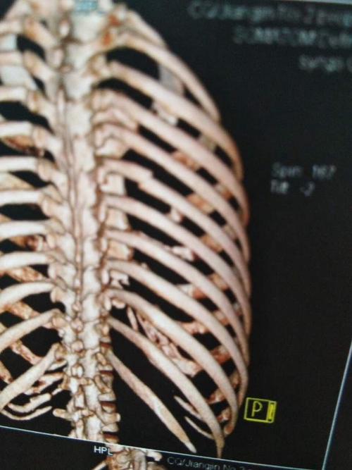 右侧第六根肋骨断裂要如何治疗