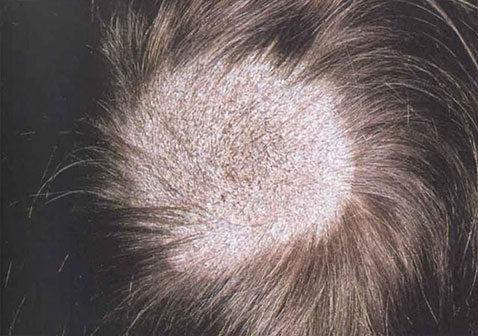 头皮癣:灰斑癣小孢子菌是最常见的真菌,但现在是一种罕见的头皮癣的