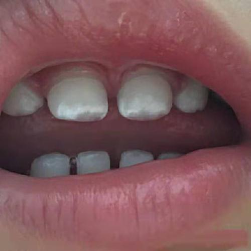 儿童专业牙膏护牙剂宝宝牙齿上有白点别忽视