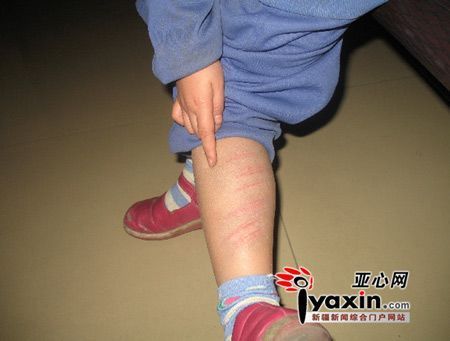 受伤孩子给亚心网记者指着他腿上清晰可见的抽打红色印痕.