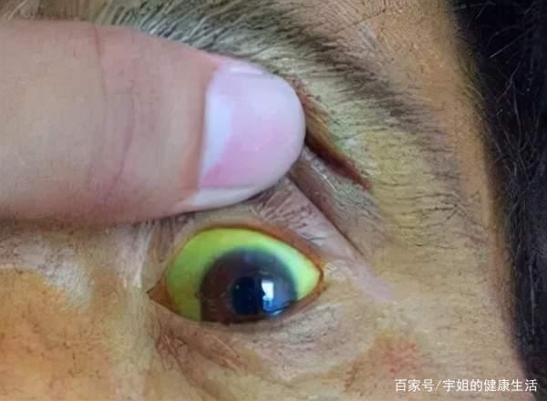 眼睛巩膜发黄,是诊断肝脏疾病的重要依据!