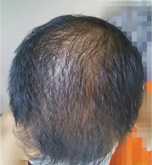 8年遗传性脱发,治疗一年这效果能打几分?(附带五位发友案例)
