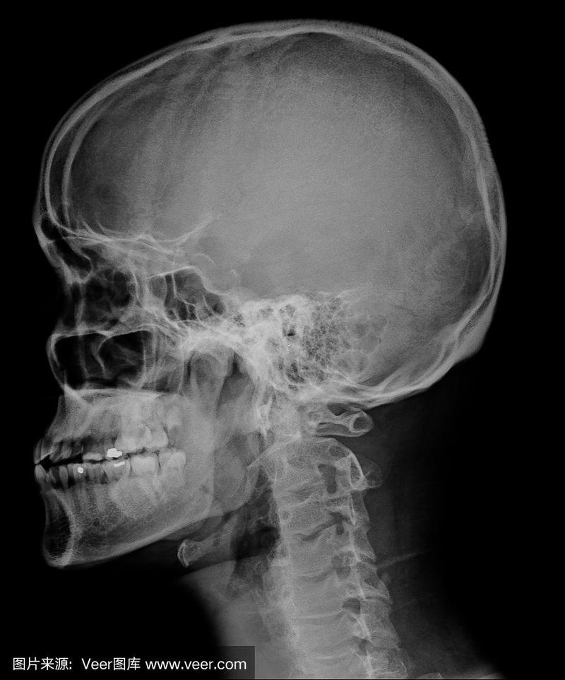 人的头部,x光,头骨,侧面视角,垂直画幅