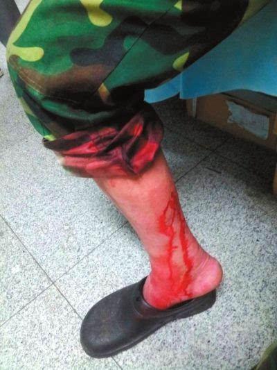 一名伤者小腿被咬出血.京华时报记者王婧摄