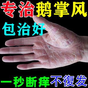 鹅掌风治手裂的药膏真菌感染干裂脱皮手足癣去根手脱皮手上小水泡