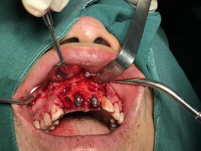 上颌骨囊肿及根尖囊肿摘除及上前牙拔除即刻种植分享 - 好大夫在线