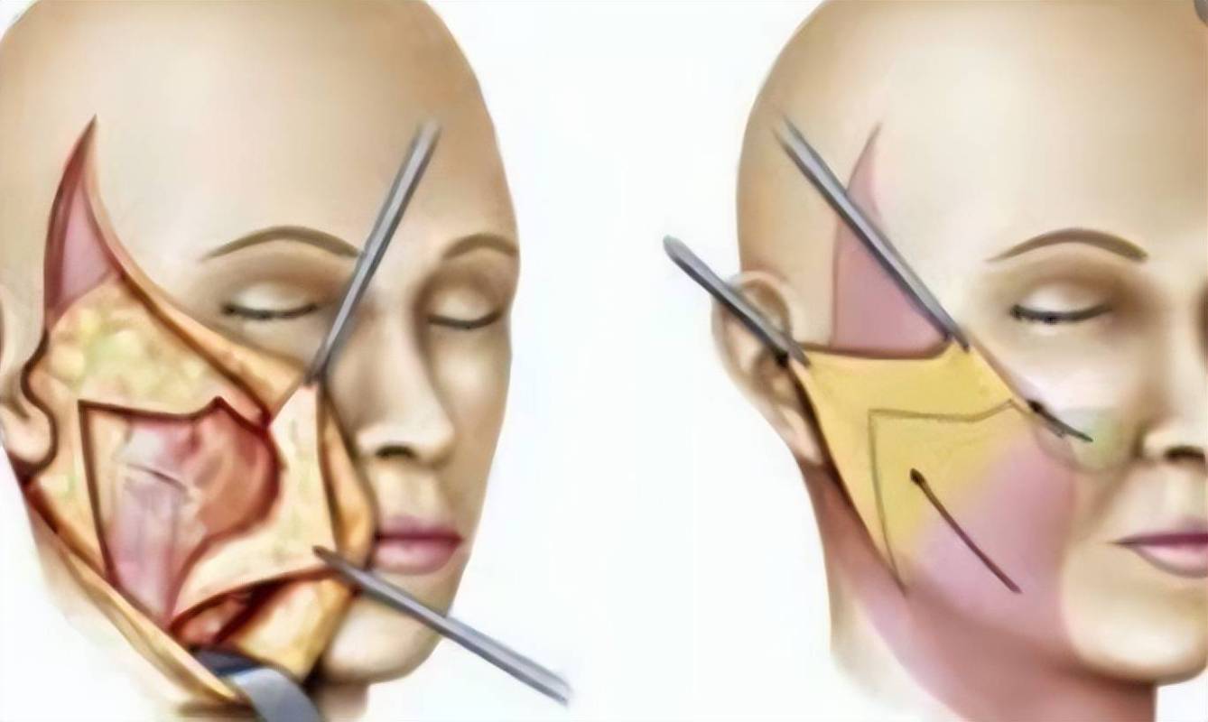 案例来了做完拉皮手术12天图片脸部手术拉皮真人图片