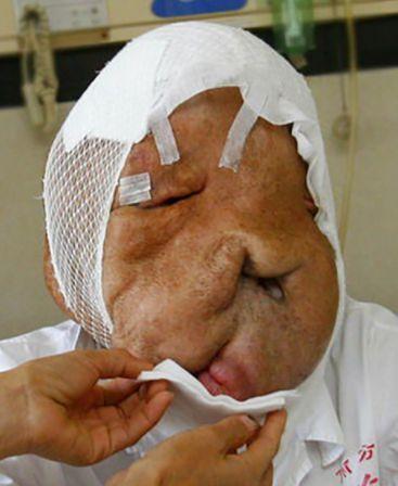 农村男子得怪病脸上长30斤肉瘤21年不敢出村见人