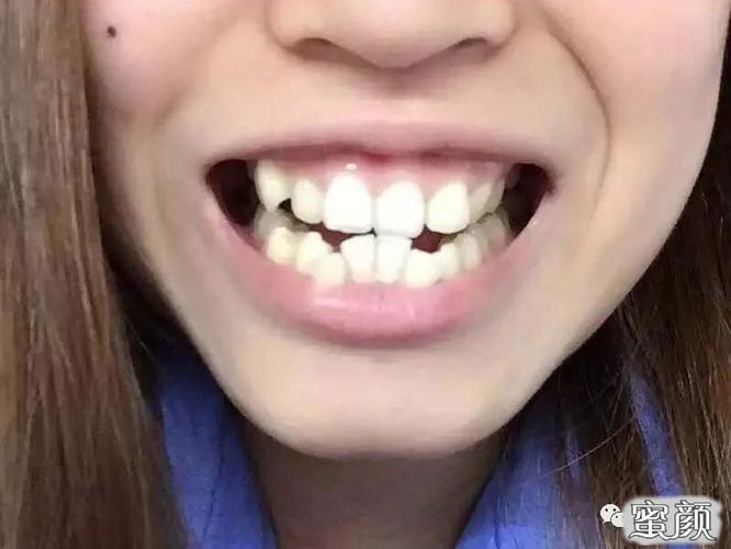 美然牙齿不齐骨性龅牙拔了8颗牙矫正3年半我终于从一个龅牙妹变成一个