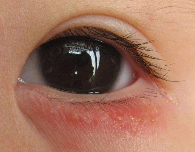 在生活中眼皮出现了浮肿的情况的话很大的一部分原因可能是因为个人的