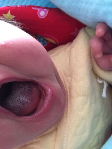 二十天的婴儿,舌头总是白白的,是奶渍还是鹅口疮,求鉴别