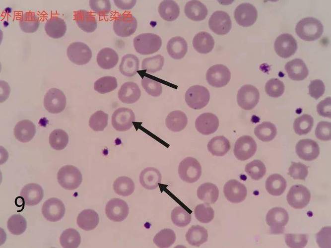 ▼「靶形红细胞」形态特征:细胞中央深染,外围苍白,边缘又深染,呈靶状