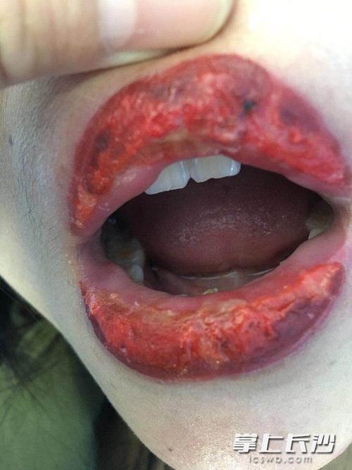 悲剧长沙29岁女子美容做樱桃唇反感染变水疱唇