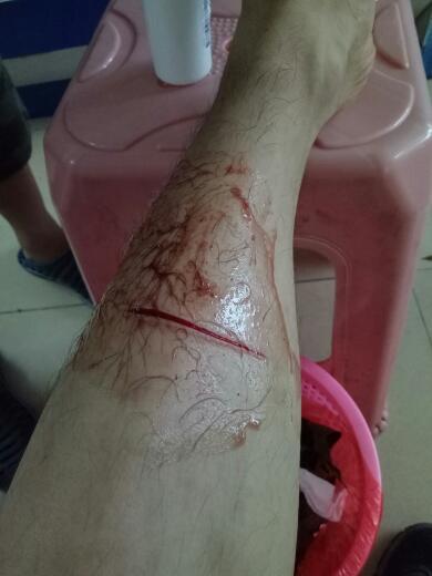 刚刚在工作中不小心被不锈钢割到脚,我想问像这种伤口要抱工伤么?