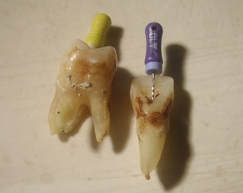 为什么死髓牙扩根管后会痛?做个小试验吧!