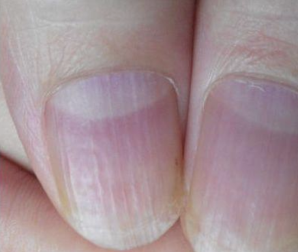 指甲月牙,指甲白点,指甲直纹,究竟代表什麼?