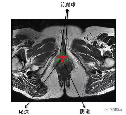 医学笔记|锋哥教你读盆腔核磁共振(2):女性经前庭球的横断面