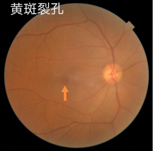 下面两图分别为黄斑裂孔的眼底照相及黄斑oct检查报告.1.