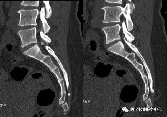 附病例(x线 ct):另外,骶尾骨骨折,特别是尾椎脱位的诊断还要和临床