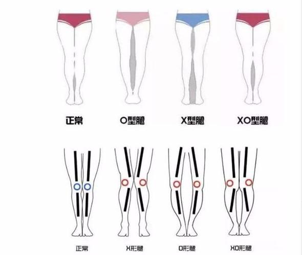 一张图教你自测你是哪种腿型如何解决o型腿问题