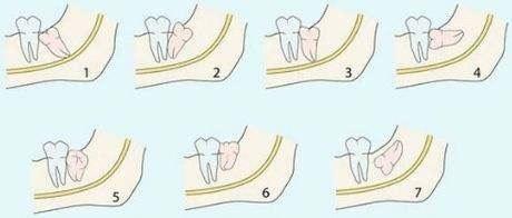 最常见的阻生牙是下颌第三磨牙(智齿),其次是上颌第三磨牙和上颌尖牙.