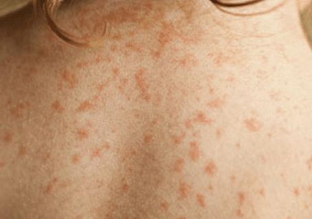 当人的皮肤感染螨虫,免疫系统就会被激活,从而产生抵抗通常无害物质的