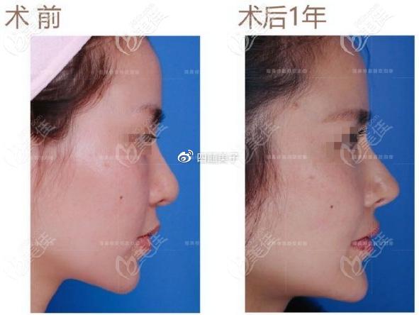 梳理广州欧阳春隆鼻价格表告诉你他做鼻修复一般需要多少钱