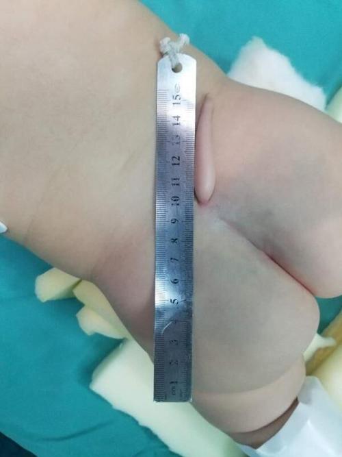 女婴骶尾部长了小尾巴在安徽省儿童医院成功手术