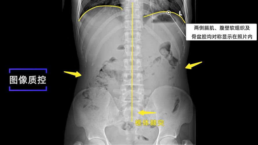 x线规范化检查腹部前后位摄影视频及图文详解
