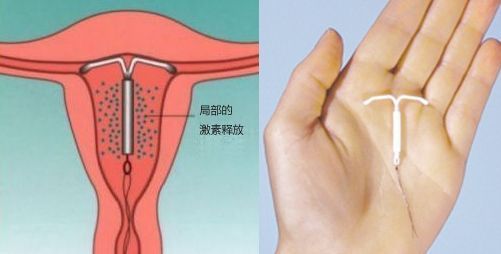 含孕激素的宫内节育器,作用示意图(左)和实物(右)