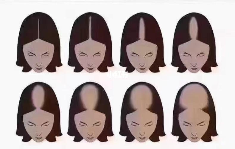女性脱发的演变史,不会像男性一样出现"地中海",而是从中分开始_脱发