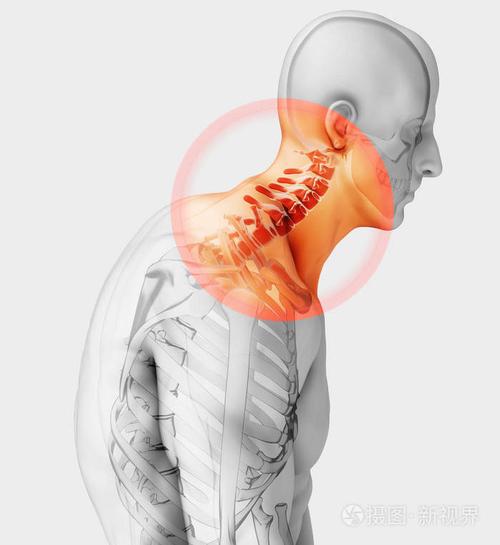3d图脖子痛颈椎骨骼x射线医疗概念