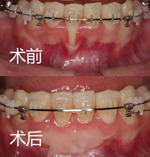 膜龈手术堪称牙龈美容术,根据不同程度,不同类型的牙龈萎缩,采用相应