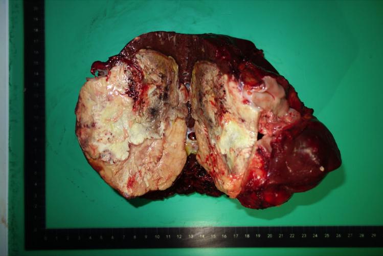 这个病例我们在术中证实右肝静脉及中肝静脉被肿瘤侵犯,左肝静脉可以