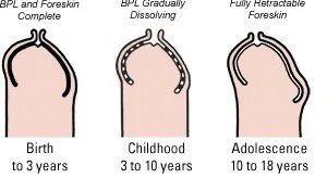 绝大多数3岁以内的男宝宝,"包茎"是非常常见的,随着年龄的增加,"包茎"