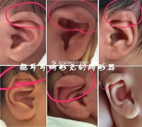 先天性耳廓形态畸形之二垂耳