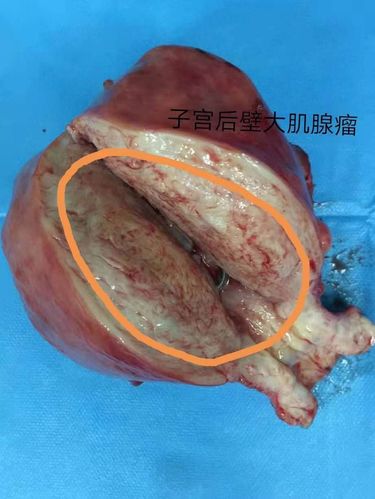 此为患者子宫后壁的一个大肌腺瘤,可见子宫严重变形,宫腔内可见节育环