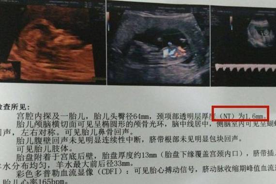 孕早期b超单上的这两个数据,暗示了胎儿"小秘密",孕妈别忽略_检查_mm