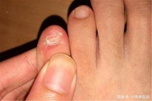 小脚指甲不全的人,真的是纯种汉族人吗?民间说法是否有依据?