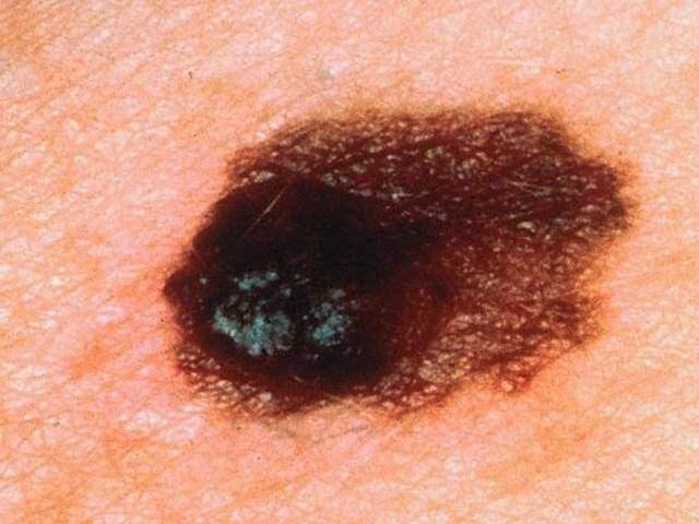 它是由良性黑色素痣或者是先天性的黑痣恶化而形成,而且这种黑色素瘤
