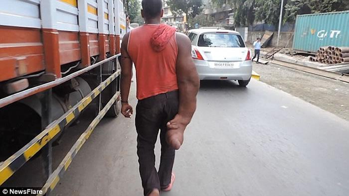 印度男子患局部巨人症右臂重20公斤被称魔鬼的孩子