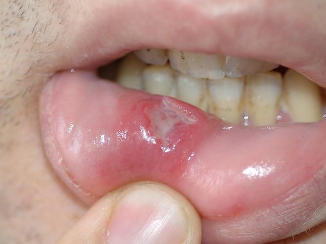 口腔溃疡的症状表现如何鉴别