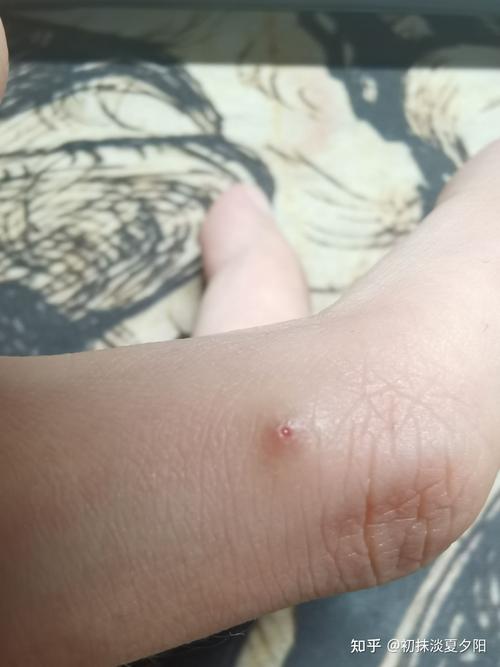 不知道被什么虫子咬了一直有个小孔伤口四个月了一直没有愈合还特别痒