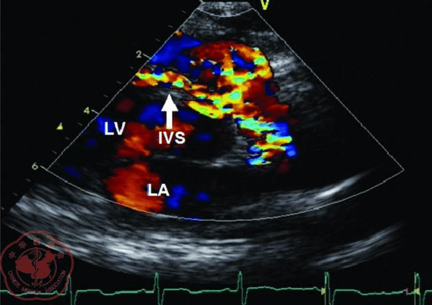 超声心动图诊断左冠状动脉异常起源于肺动脉二例