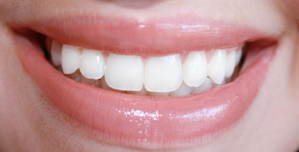 teeth whitening take two!